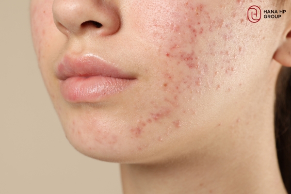 da bị break out là gì