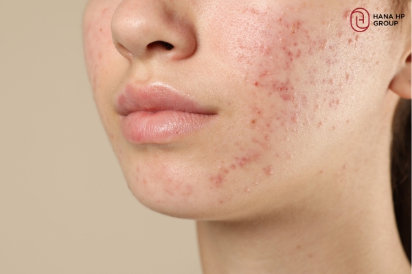 Tẩy da chết cho da hỗn hợp thiên dầu