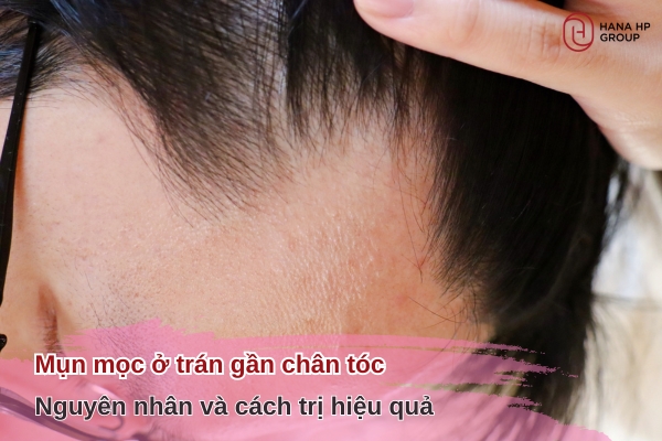 Mụn mọc ở trán gần chân tóc: Thủ phạm bạn không ngờ tới 4 mụn mọc ở trán gần chân tóc