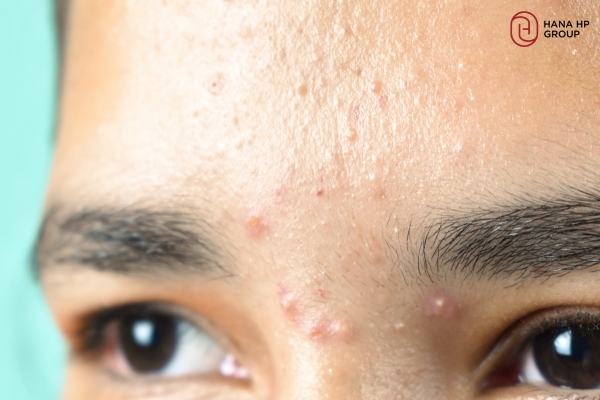 tretinoin và retinol khác nhau như thế nào