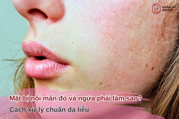 Mặt bị nổi mẩn đỏ và ngứa phải làm sao? Cách xử lý chuẩn da liễu 2 mặt bị nổi mẩn đỏ và ngứa phải làm sao