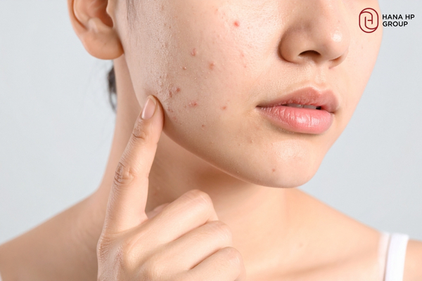 dùng AHA BHA PHA có bị đẩy mụn không