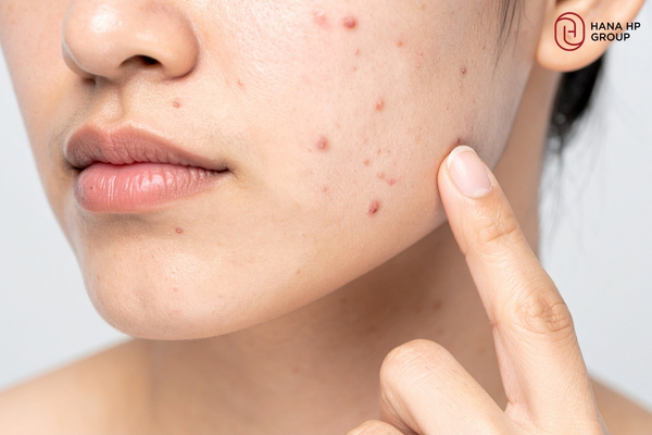 dùng AHA BHA PHA có bị đẩy mụn không