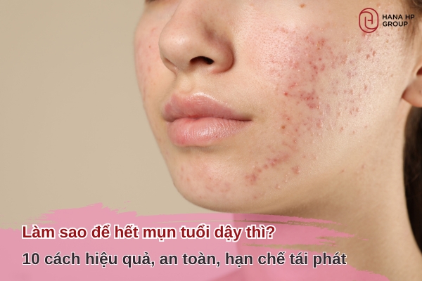 Làm sao để hết mụn tuổi dậy thì? 10 Cách hiệu quả, an toàn, hạn chế tái phát 10 làm sao để hết mụn tuổi dậy thì
