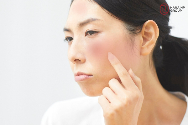 dùng AHA BHA PHA có bị đẩy mụn không