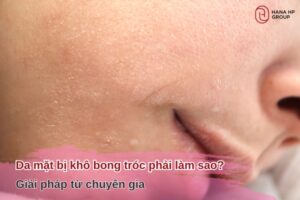 da mặt bị khô bong tróc phải làm sao