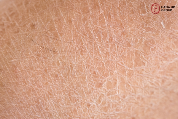 Ngâm mặt bằng nước đá