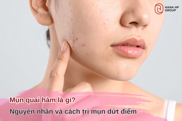 Mụn quai hàm: 5 Nguyên nhân nhiều người không biết 9 mụn quai hàm