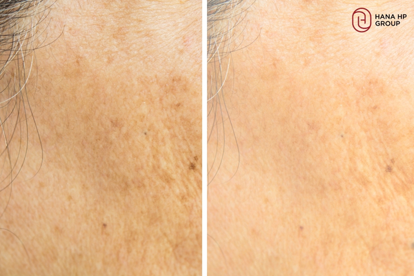 Các mảng nám mờ đi đáng kể sau 12 tuần Các mảng nám mờ đi đáng kể sau 12 tuần