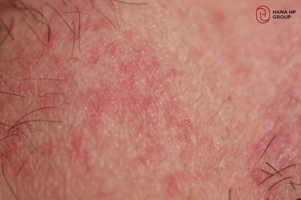 Cần ngưng dùng Tretinoin/Adapalene khi thấy da ửng đỏ kích ứng