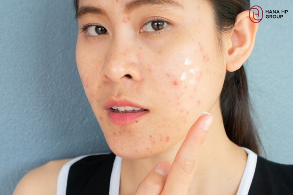 Da mụn nên chọn kem chống nắng vật lý hoặc kem chống nắng lai