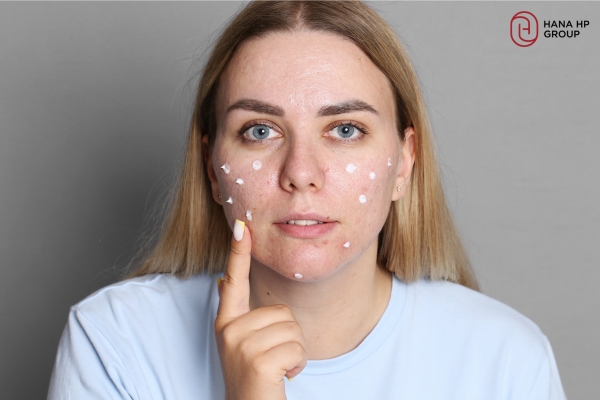 Review sản phẩm trị mụn có chứa Axit Salicylic cho từng loại da 1 sản phẩm trị mụn có chứa Axit Salicylic