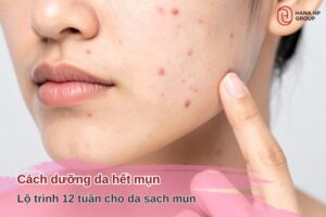 Cách dưỡng da hết mụn