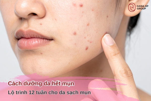 Cách dưỡng da hết mụn