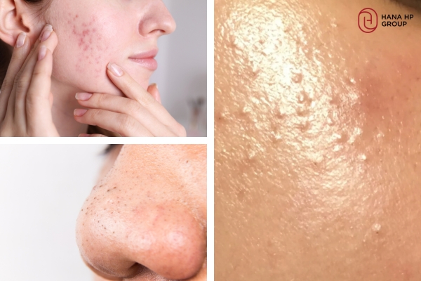 Cách dưỡng da hết mụn