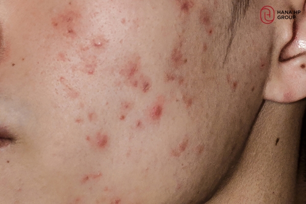 Phục hồi da nhiễm Corticoid: Cách phục hồi an toàn cho từng giai đoạn 1 Phục hồi da nhiễm corticoid