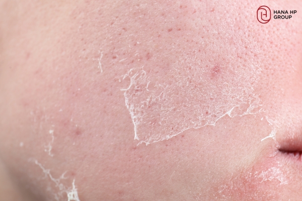Phục hồi da nhiễm Corticoid: Cách phục hồi an toàn cho từng giai đoạn 2 Phục hồi da nhiễm corticoid