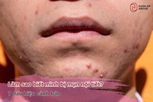 làm sao biết mình bị mụn nội tiết