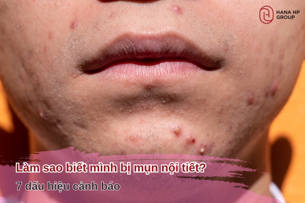 làm sao biết mình bị mụn nội tiết