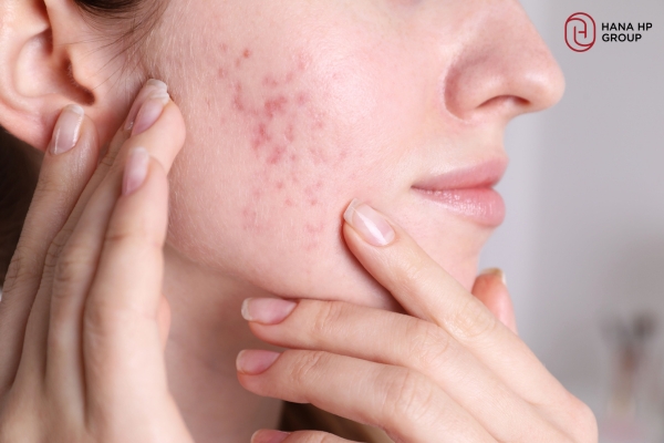 làm sao biết mình bị mụn nội tiết