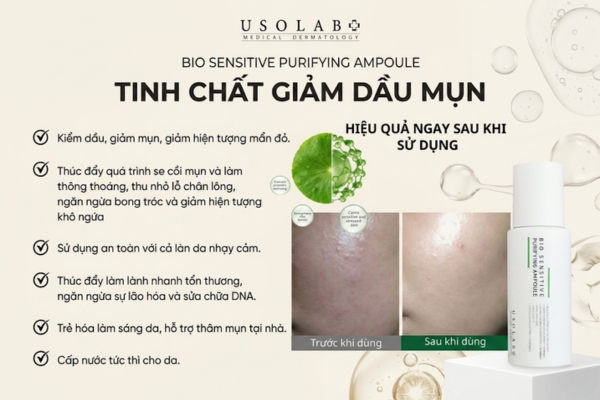 làm sao biết mình bị mụn nội tiết