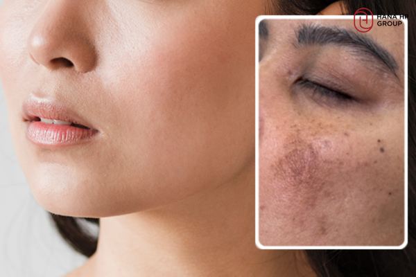 cách chăm sóc da sau khi bắn laser trị nám