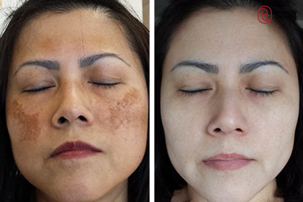 cách chăm sóc da sau khi bắn laser trị nám