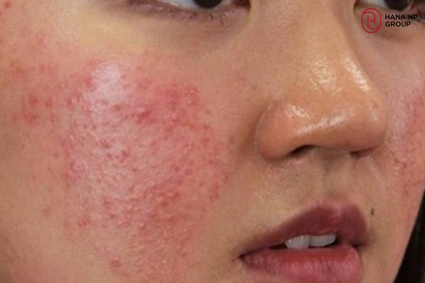 cách chăm sóc da sau khi bắn laser trị nám
