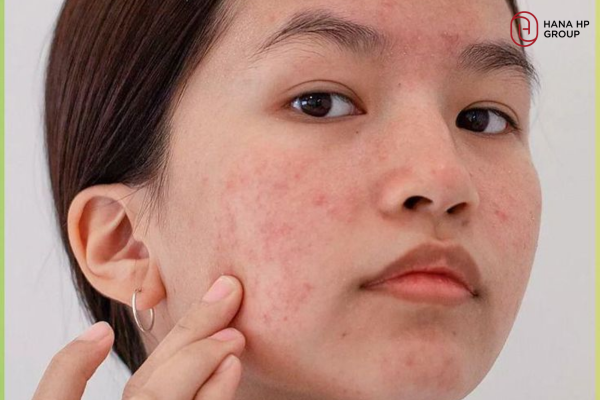 cách phục hồi da nhạy cảm
