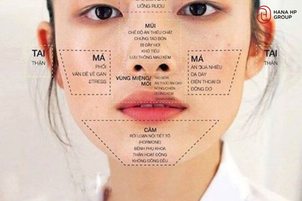 mụn mọc quanh miệng và cằm ở nữ giới