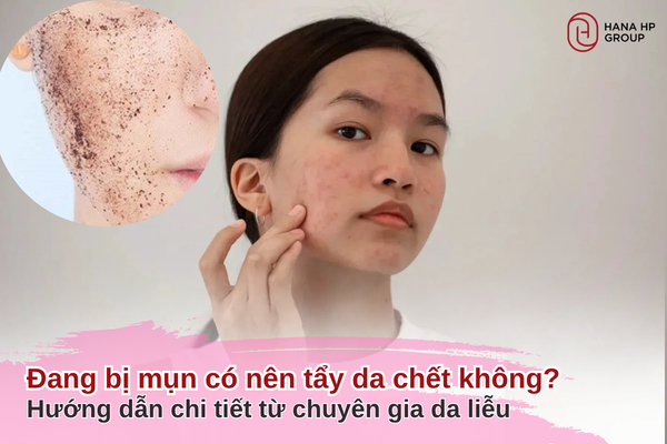 đang bị mụn có nên tẩy da chết