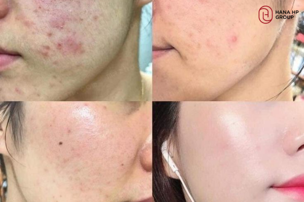 mặt nạ đất sét có tẩy da chết không