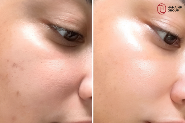 dùng retinol có cần tẩy da chết không