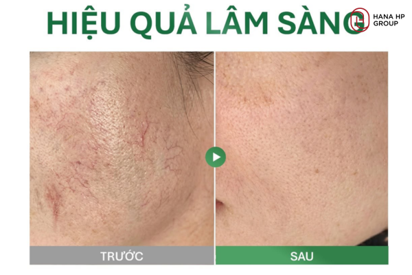 kem dưỡng cho da dầu mụn